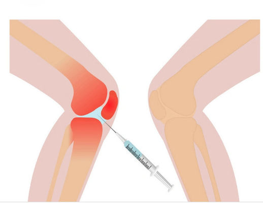 3ml Roztwór do mezoterapii bólu kolana Nieusieciowany kwas hialuronowy