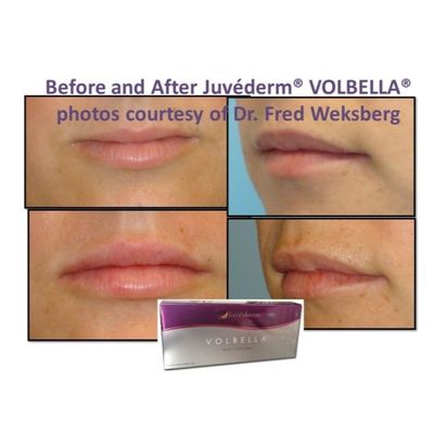 Tłumacz twarzy z kwasem hialuronowym Juvederm Gładka i bezbłędna skóra