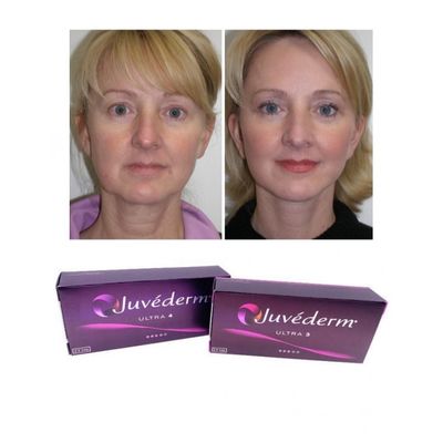 Długość działania 6-9 miesięcy Juvederm Dermal Filler Gel do zakupu online i w sklepie