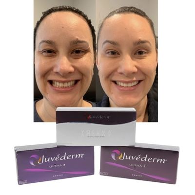 Juvederm Dermal Lip Fillers Hyaluronic Acid Cross Linked Injection