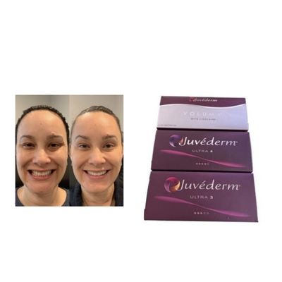Usieciowany wypełniacz skórny HA Juvederm Ultra3 Ultra4 Voluma Warunki przechowywania Unikać zamrażania Żel do wstrzykiwań do przywracania objętości twarzy